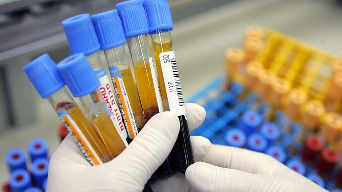 Simple Blood Test Can Predict Dementia 25 Years in Advance, Study Suggests - Gizmodo